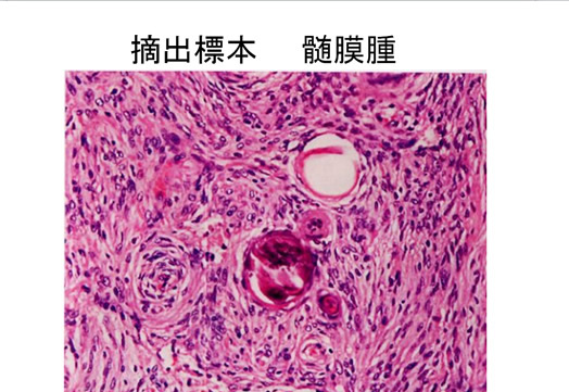 摘出標本 髄膜腫