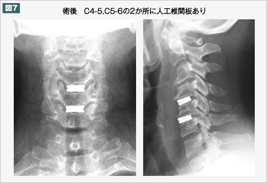術後 C4-5,C5-6の2か所に人工椎間板あり