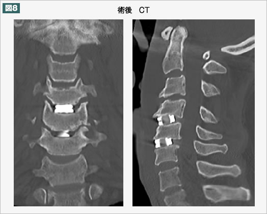 術後 CT
