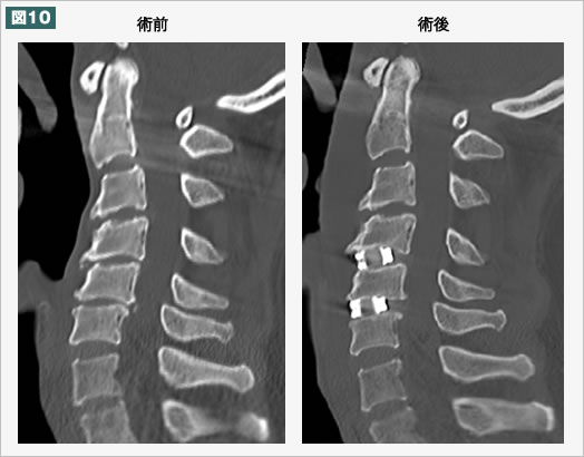 術後 CT