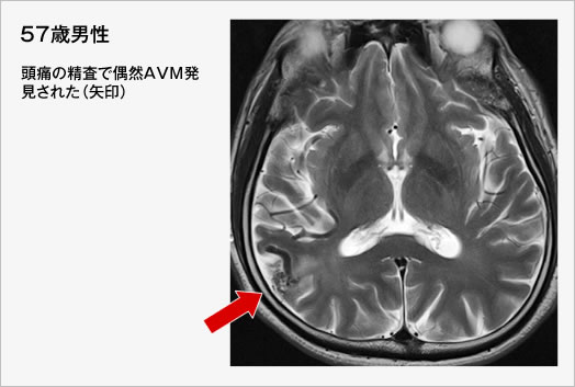 57歳男性 頭痛の精査で偶然AVM発見された(矢印)