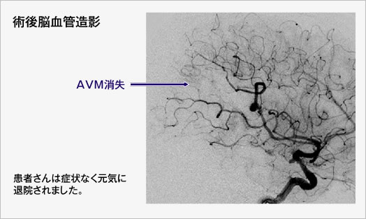 術後脳血管造影　患者さんは症状なく元気に退院されました。